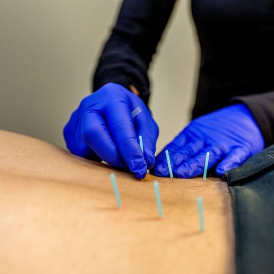 درای نیدلینگ (سوزن خشک)